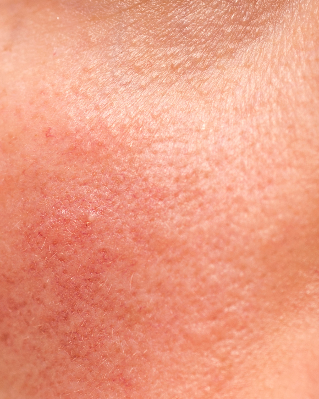 What Is Inflammation?